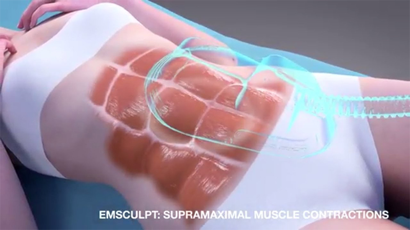 emsculpt treatment of buttocks