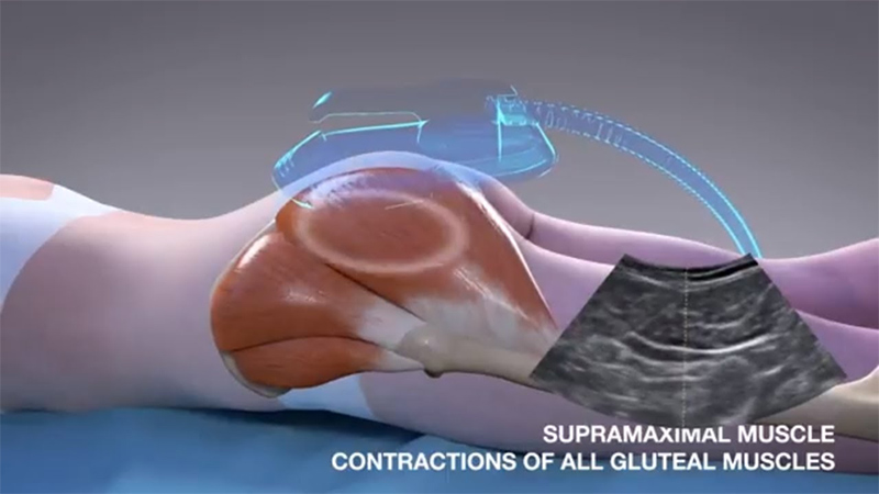 emsculpt treatment of buttocks